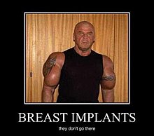implants.jpg